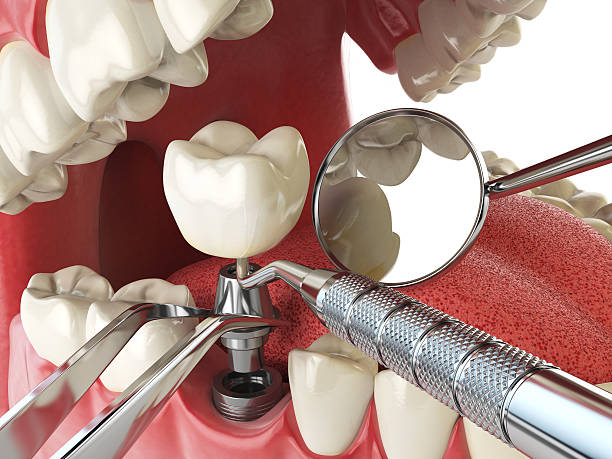 Teeth Whitening in MD